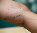 SCAI publishes first clinical guidelines for managing chronic venous disease