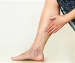 UT Physicians provide no-cost online varicose vein screening program