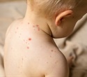 COVID-19 pandemic linked to diminishing public trust in childhood vaccines
