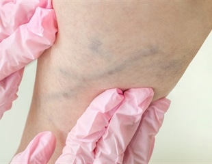 New PET radiotracer shows high accuracy for detecting clots in the legs and lungs