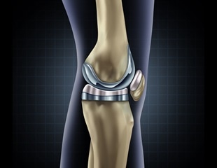 Study finds gaps in home rehab after joint replacement