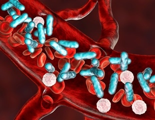 Early TB treatment before sepsis diagnosis could save countless lives