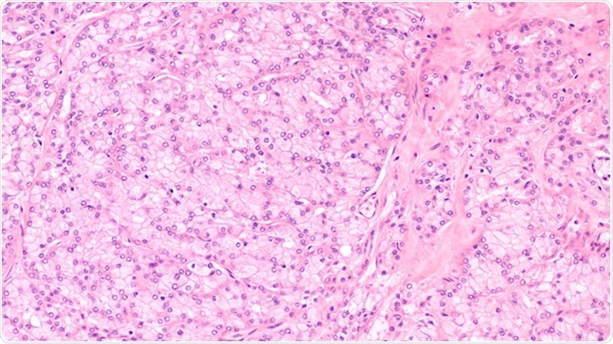 Microscopic image of an acinic cell carcinoma, a rare cancer of salivary glands such as parotid, submandubular or sublingual gland. They derive from acinar cells and have finely granular cytoplasm. - Image Credit: By David Litman / Shutterstock