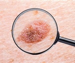 Tips to prevent sunburn and reduce risk of skin cancer