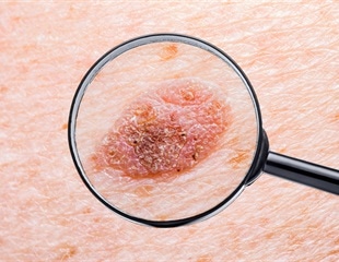 Discovery may help develop new treatments for immunosuppressed skin cancer patients