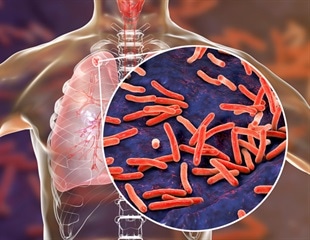 FDA approves effective new treatment for extremely drug-resistant tuberculosis