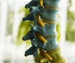 Study provides insight into potential mechanisms underlying diabetes-related disc tissue damage