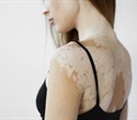 Dormant melanocytes found in vitiligo offer hope for future repigmentation therapies