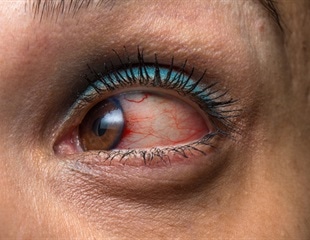 International coalition develops classification criteria for 25 subtypes of uveitis