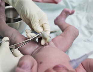 Chlorhexidine reduces umbilical cord infections in newborns