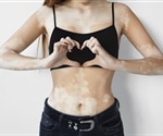 Vitiligo Symptoms, Diagnosis, and Treatment
