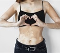 Dormant melanocytes found in vitiligo offer hope for future repigmentation therapies