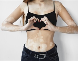 Dormant melanocytes found in vitiligo offer hope for future repigmentation therapies
