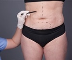 Pros and cons of weight loss surgery in men and women