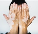 Dormant melanocytes found in vitiligo offer hope for future repigmentation therapies