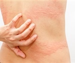 FDA approves Xolair for treatment of chronic idiopathic urticaria