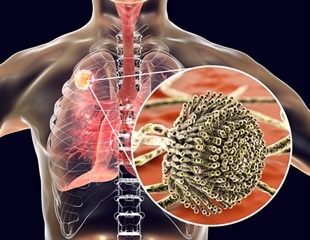 COVID-19-associated pulmonary aspergillosis caused by aspergillus fumigatus