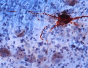 Amyloid beta misfolding predicts Alzheimer's years before symptoms appear