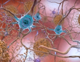Hormone replacement therapy may reduce dementia risk for some women