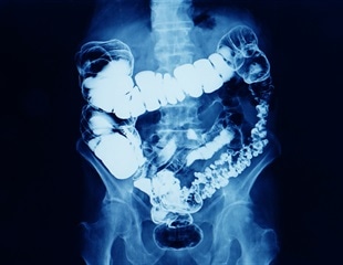 Bowel cancer on the up in England’s young adults