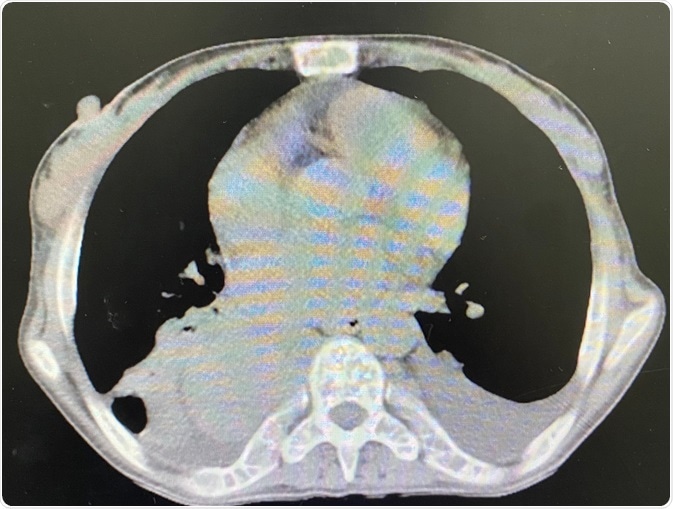 Mediastinal Mass Mediastinal Mass