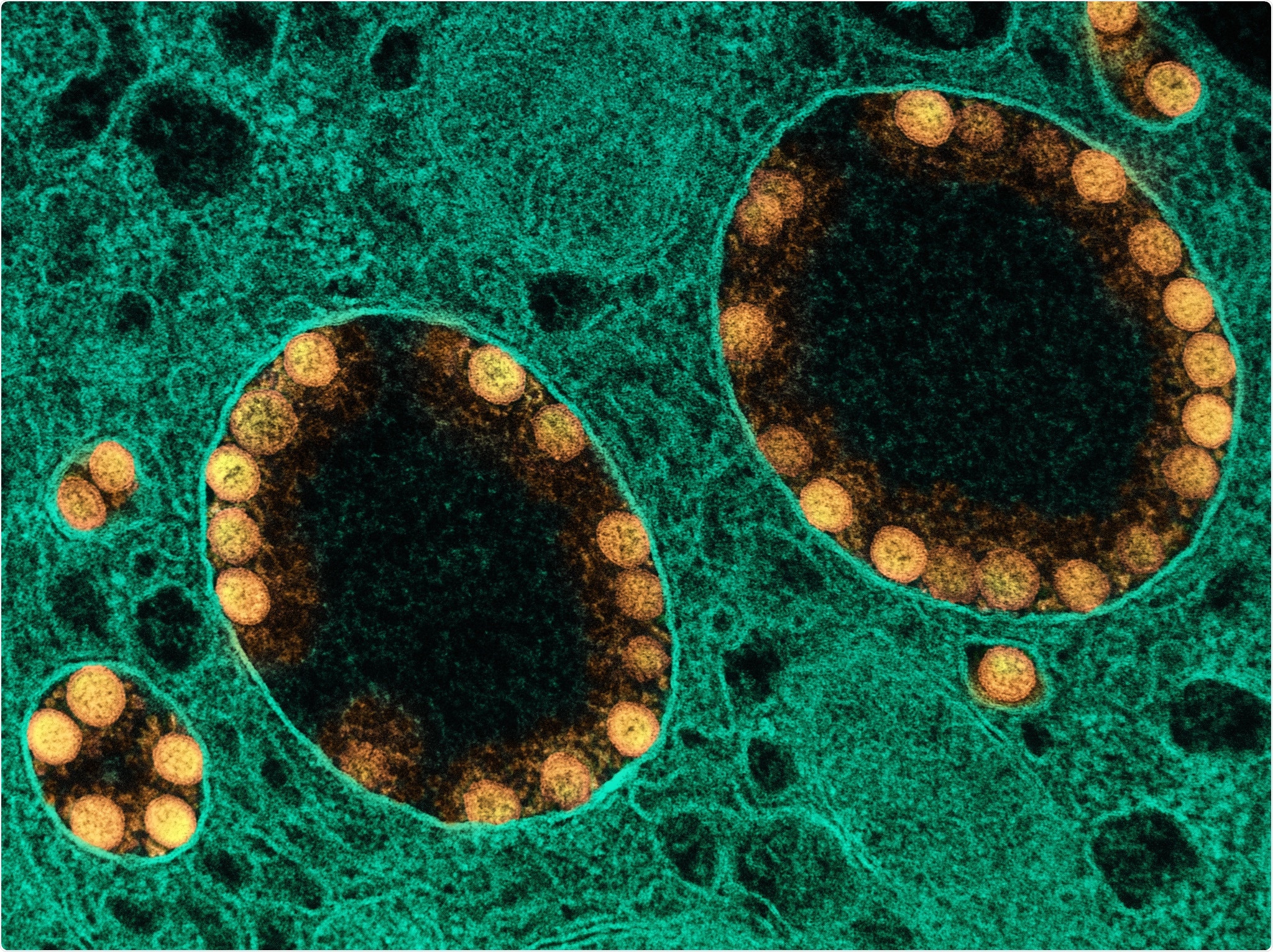 Study: Association of Prior SARS-CoV-2 Infection With Risk of Breakthrough Infection Following mRNA Vaccination in Qatar. Image Credit: NIAID