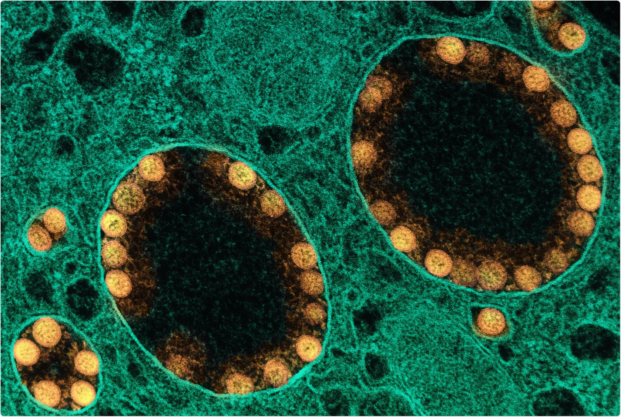 Study: Lasting Changes to Circulating Leukocytes in People with Mild SARS-CoV-2 Infections. Image Credit: NIAID