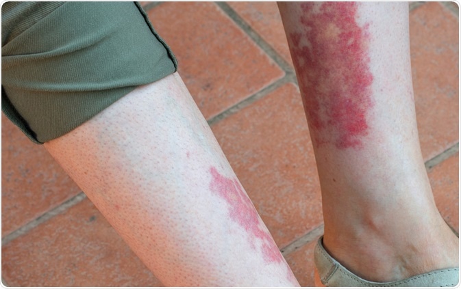 vasculitis