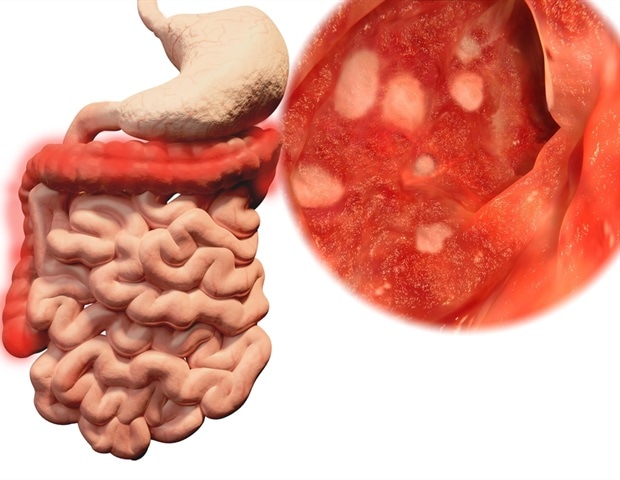 tirzepatide ulcerative colitis and Colitis: Safety Guide ulcerative colitis and tirzepatide Ulcerative