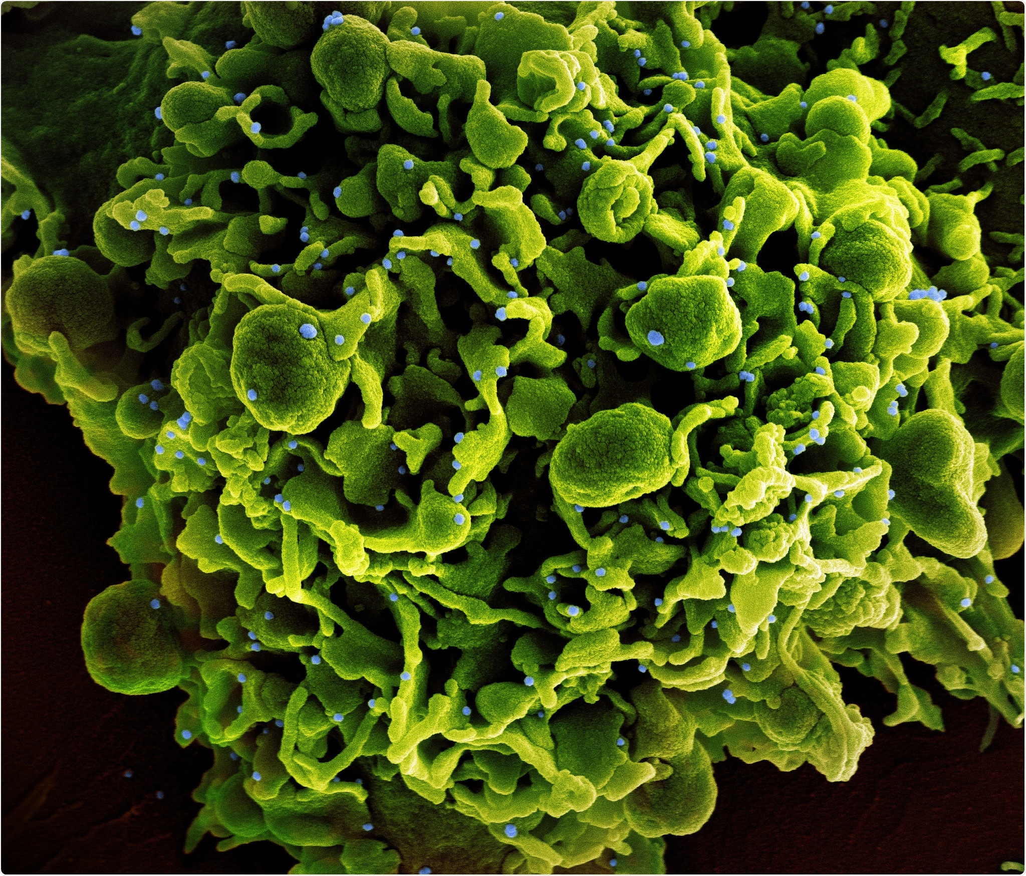 Colorized scanning electron micrograph of a cell (green) infected with SARS-CoV-2 virus particles (blue, isolated from a patient sample. Image captured at the NIAID Integrated Research Facility (IRF) in Fort Detrick, Maryland. Credit: NIAID