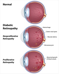 tirzepatide and diabetic retinopathy Frontiers Diabetic retinopathy is a complication