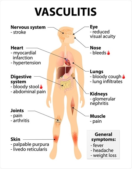 Vasculitis Affecting Small Blood Vessels: ANCA-Associated and Non-ANCA