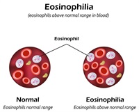 eosinophilia and glutathione Marked is detected in patient's peripheral blood smear (a) Regulation of the Production and