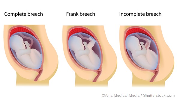 Breeched Birth: Caesarean Section or Vaginal Delivery?