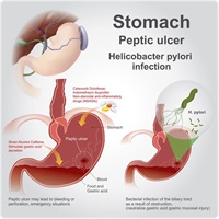 can cigarettes cause stomach ulcers Living with Peptic Ulcer Disease