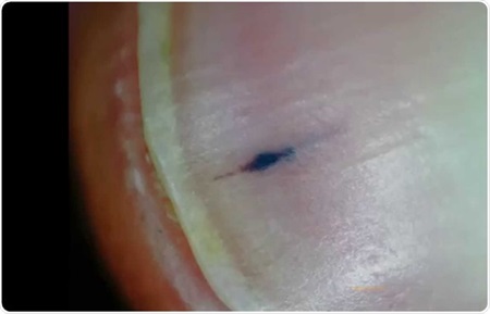 Splinter Hemo Splinter Hemorrhages