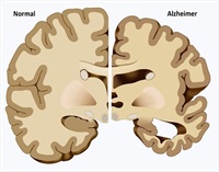 dihexa dementia What Causes Dementia?