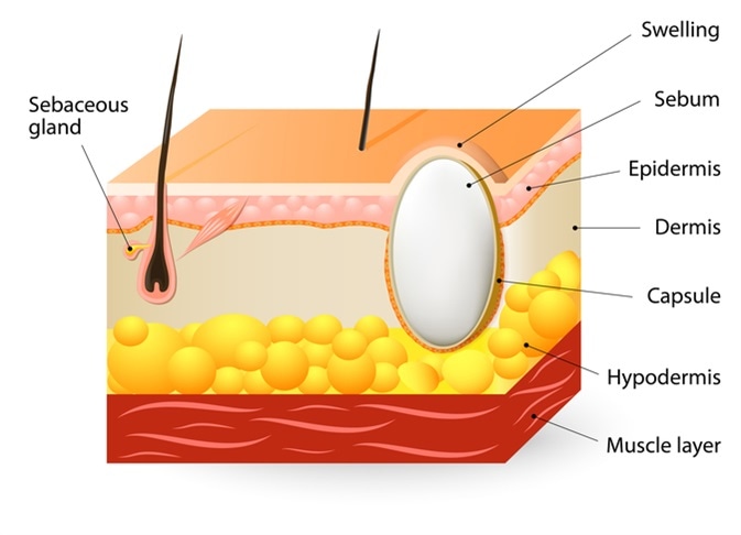 Skin Cysts (Sebaceous Cyst)