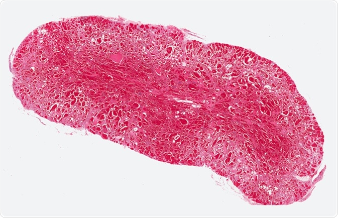 Angiosarcoma Diagnosis