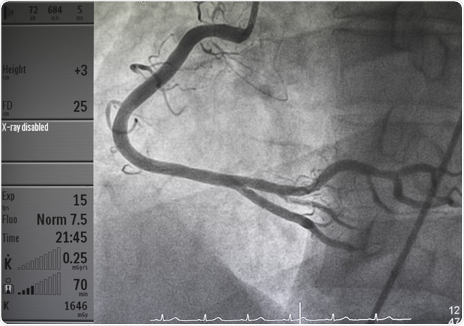 What is an Angiogram?