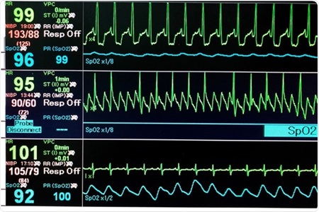 Infantile Bradycardia Causes, Diagnosis, Symptoms and Treatment