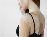 can glutathione help vitiligo Vitiligo Treatment