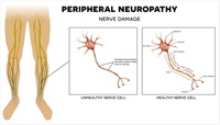 peripheral neuropathy tirzepatide Types Tirzepatide and Metformin Together: Combination