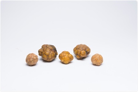 Symptoms and Diagnosis of Bladder Stones