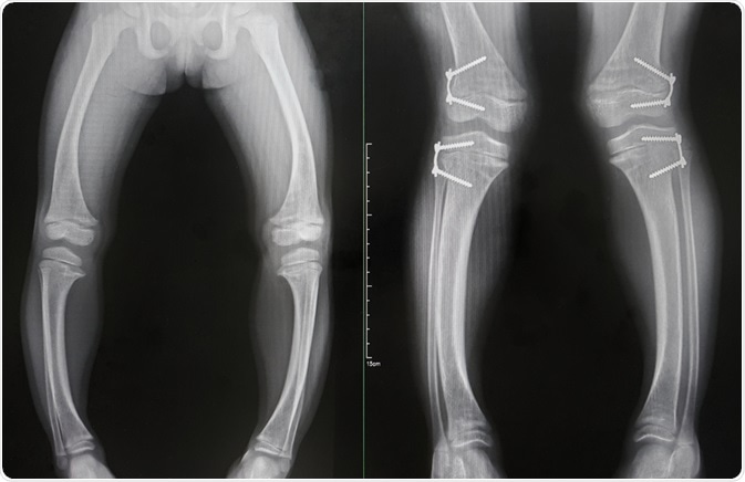 Rickets Treatments