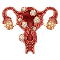 Uterine Fibroids Treatment