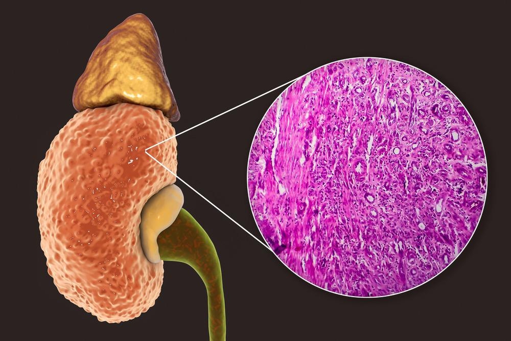 Nephrocity What is Nephrotoxicity?