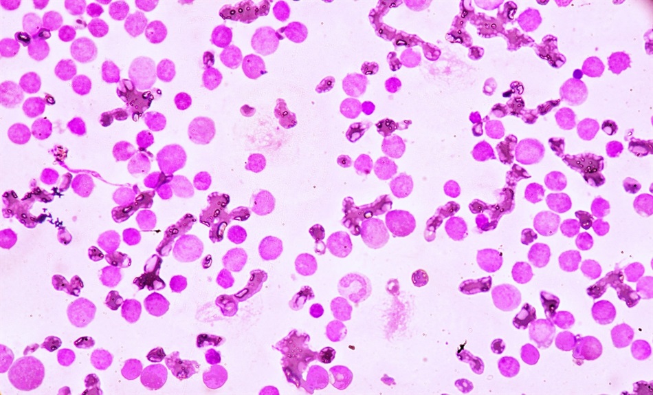 What is Acute Promyelocytic Leukemia (APL)?