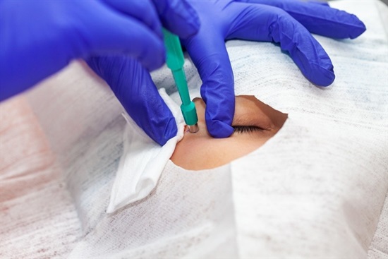 Punch Method How and Why is a Punch Biopsy Done? (Skin)