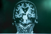 Could a diabetes drug be the key to stopping Alzheimer's?